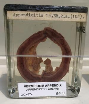 VERMIFORM APPENDIX